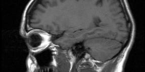 Brain Injury After Golf Cart Accident