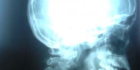 Cervical Disc Hernaition from a Car Accident | Lawsuit for Injuries