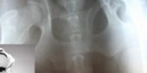 Metallosis caused by Metal on Metal Hip Replacment Implant