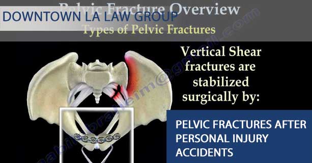 What Are Pelvic Fractures?