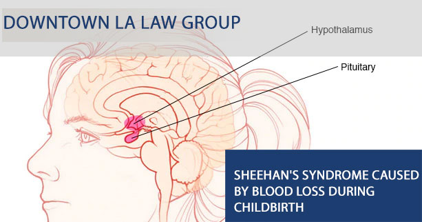 Sheehan's Syndrome Caused by Blood Loss During Childbirth - medical malpractice claim