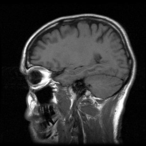 TBI _ Traumatic Brain Injury Lawsuit Information