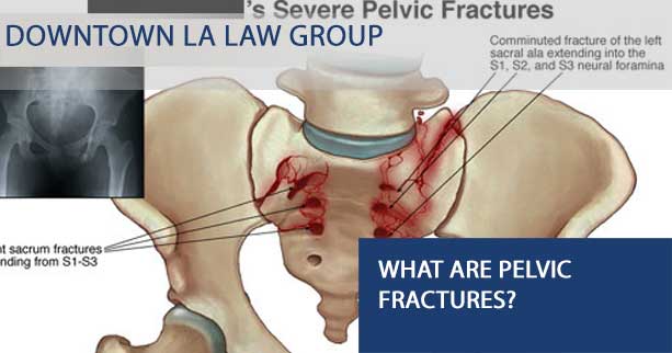 Pelvic Fractures after Personal Injury Accidents