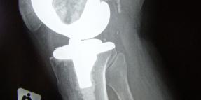 Knee Injury after A Car Accident
