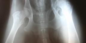Johnson and Johnson Settles First 3 DePuy Hip Replacement Cases for $600,000