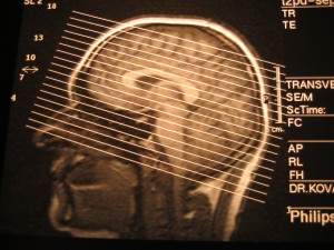 Traumatic Brain Injury Legal Guide